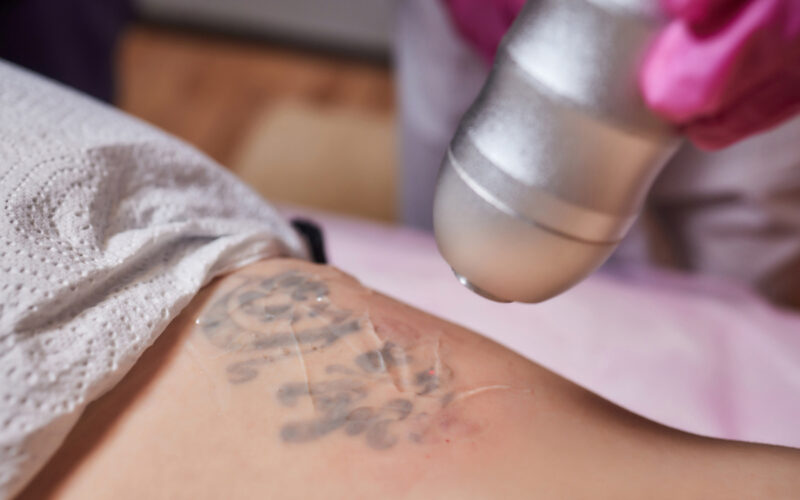trattamenti dopo la rimozione dei tatuaggi